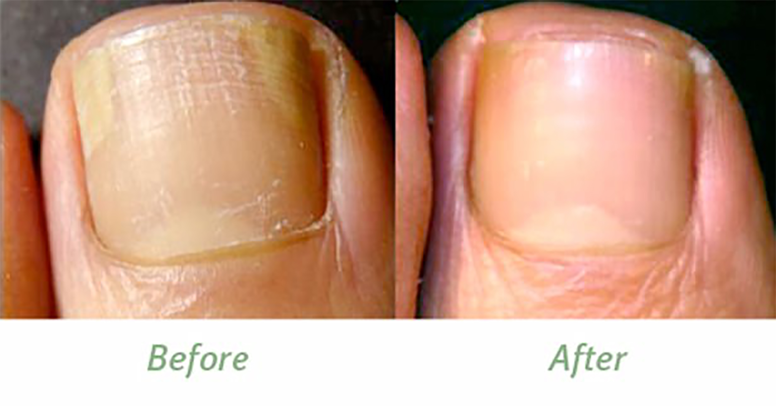 Ногти до и после лечения грибка фото.
